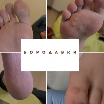Чистка пятки