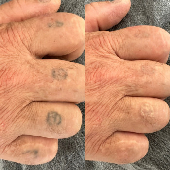 Лазерне видалення
                    Permanent Makeup Master Olha Heha Krakow