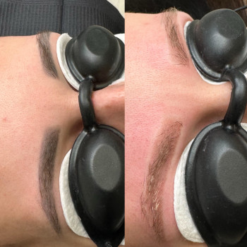 Лазерне видалення
                    Permanent Makeup Master Olha Heha Krakow