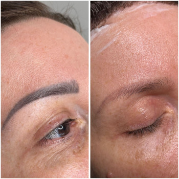 Usuwanie PMU i Tatuazu ansty beauty