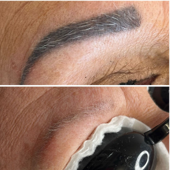 Usuwanie PMU i Tatuazu ansty beauty