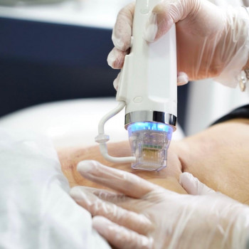 Карбоновый пилинг