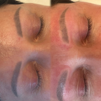 Удаление тату или перманентного макияжа