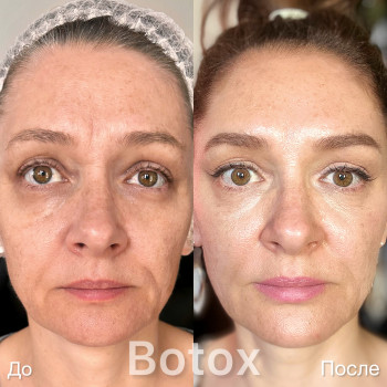 Ботокс Full Face