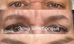 Ботокс межбровной области Kosmetyczka Anastasia  Warszawa