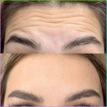 Гусиные лапки (вокруг глаз)