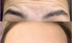 Зона лба Kosmetikerin Anastasia  Warsaw