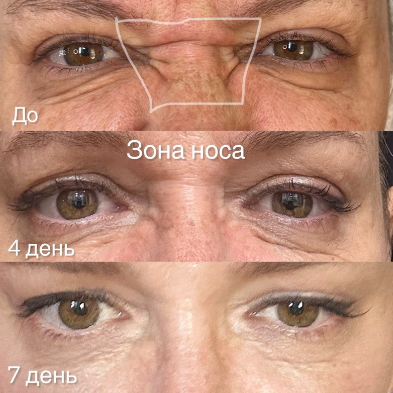 Зона носа
                    Косметолог Анастасія  Варшава