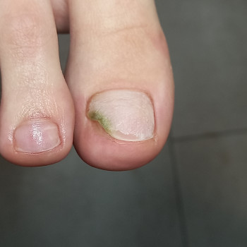 ,,Синегнойка,, - ПСЕВДОМОНИЯ - следствие покрытия ногтей с уже имеющимся ,,ОНИХОЛИЗом,,