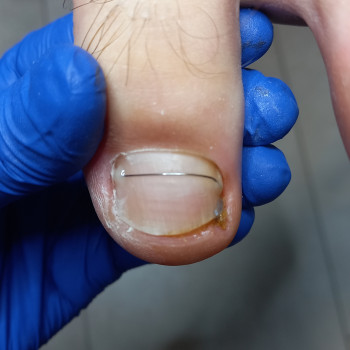 Установка коррекционной  системы ,,ТИТАНОВАЯ НИТЬ,, после удаления вросшего сегмента