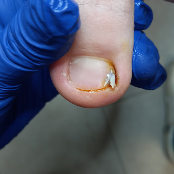 Удаление вросшей спикулы. БЕЗ БОЛИ!!