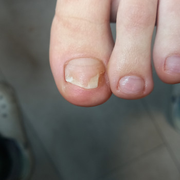 Травматический онихолиз, деформация пальцев в следствии ношения маленького размера обуви усугубленный ношением гель-лака