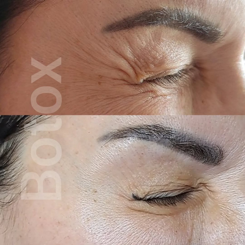 Гусиные лапки (вокруг глаз)
                    Косметолог Анастасія  Варшава