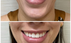 Десневая улыбка Косметолог Анастасія  Варшава