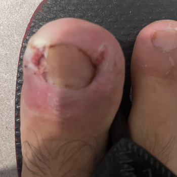 Медицинский Педикюр