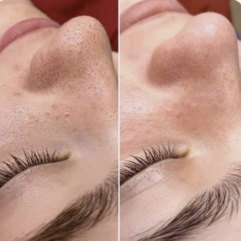 Ультразвуковая чистка лица + салициловый пилинг