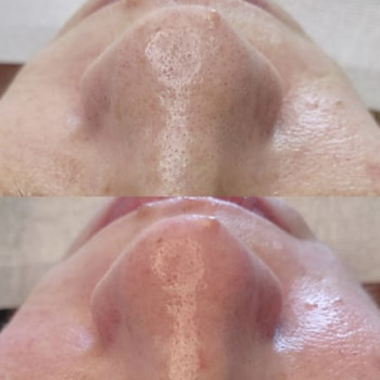 Чистка лица и пилинг в одной процедуре