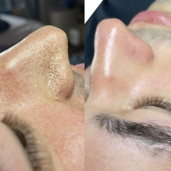 Чистка лица