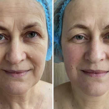 Результат:10 сеансов массажа лица