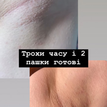 Массаж лица от морщин