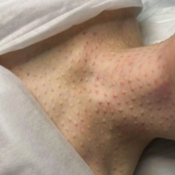 Биоревитализация
                    Косметолог-эстетист Елена Корнейчук Варшава