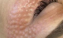 Мезотерапия в области глаз Kosmetikerin Elena Korneychuk Warsaw