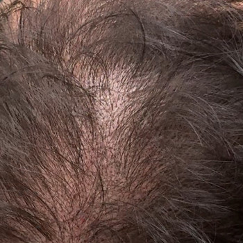 Трихопигментация