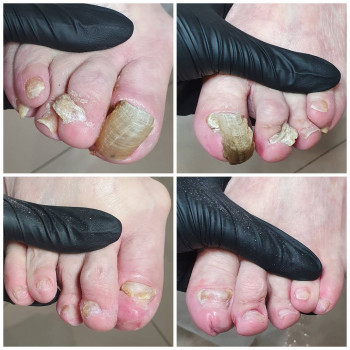 Лечение грибка ногтей