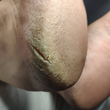 Лечение грибка ногтей