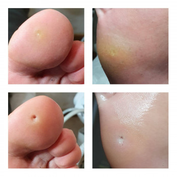 Лечение грибка ногтей