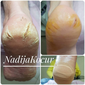 Лечение грибка ногтей