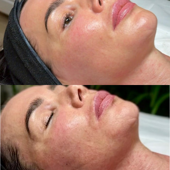 Антицеллюлитный массаж тела