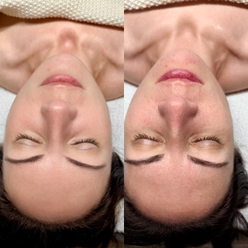 Антицеллюлитный массаж тела