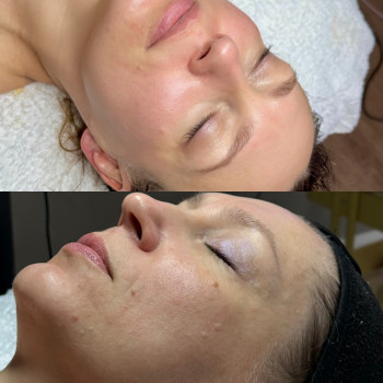 Антицеллюлитный массаж тела