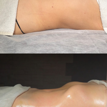 «Антикилер»
Результат за 1 процедуру