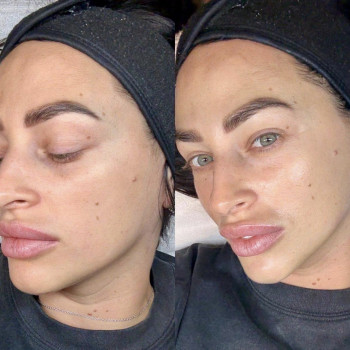 Уходовая процедура с ретинолом