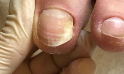 Onycholiza u paznokci stóp 1 paznokcia Manicurzysta Olena Mishuk Warszawa