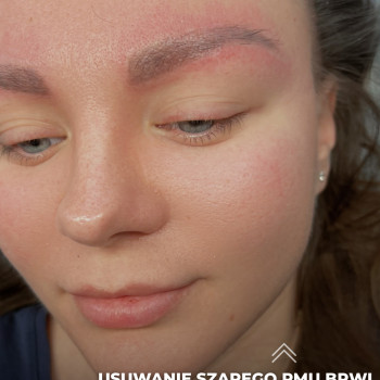 Usuwanie laserem permanentnego makijażu