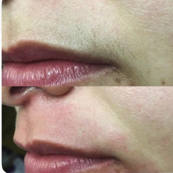 Электроэпиляция