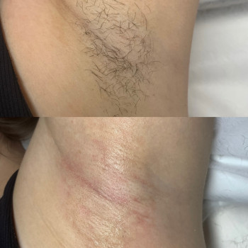 Электроэпиляция