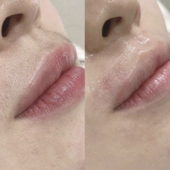 Электроэпиляция