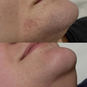 Электроэпиляция