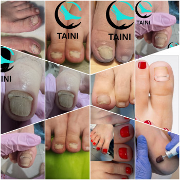 Лечение вросшего ногтя и медицинский педикюр, установка титановой нити