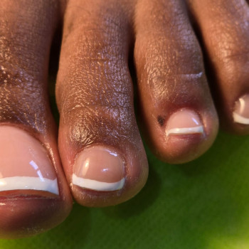 Лечение вросшего ногтя и медицинский педикюр, установка титановой нити