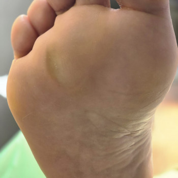 Лечение вросшего ногтя и медицинский педикюр, установка титановой нити