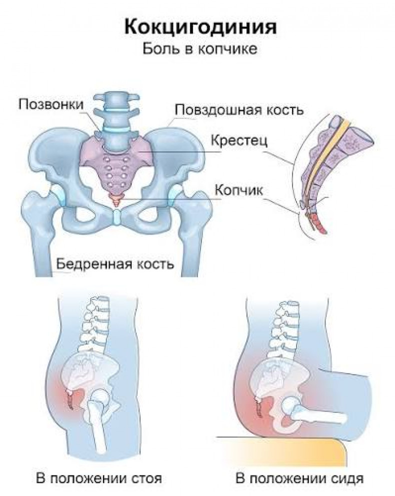 Кокцигодиния - боль в копчике