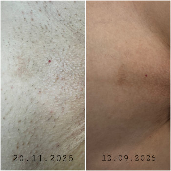 Efekt depilacji laserowej, 5 zabiegów rok czasu