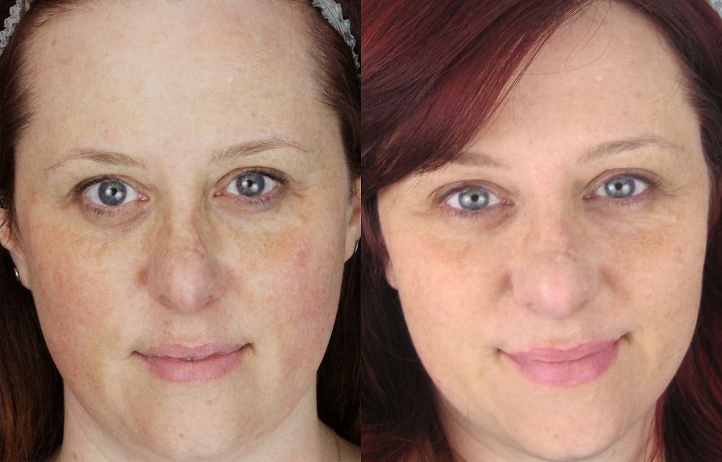 Фото до и после ретиноевого пилинга
