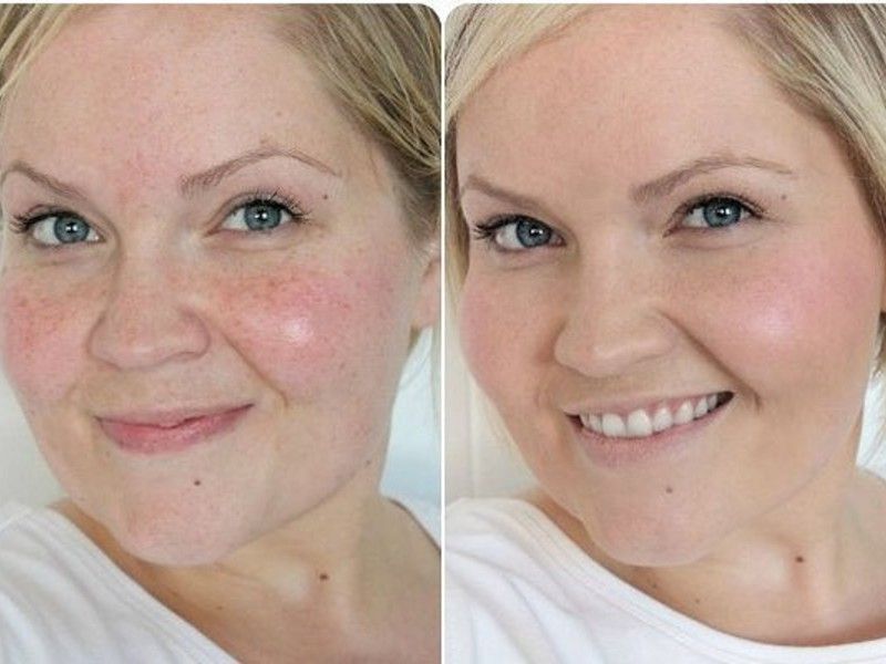 До и после ручной чистки лица