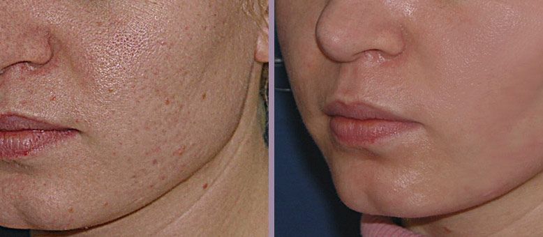 Фото до и после ультразвуковой чистки лица
